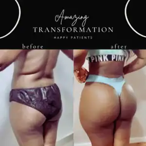 How to Tell If Your BBL Is Aging – Signs & Fixes from Experts 13 Brazilian Butt Lift (BBL) in Lake Worth.
