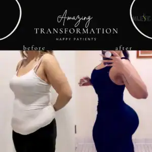 Brazilian Butt Lift BBL Lake Worth FL - Majestic Aestheticsjestic Aesthetics Brazilian Butt Lift BBL Lake Worth FL - Majestic Aesthetics