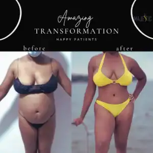 Awake Liposuction Delray Beach FL 2 awake liposuction Delray Beach before and after example