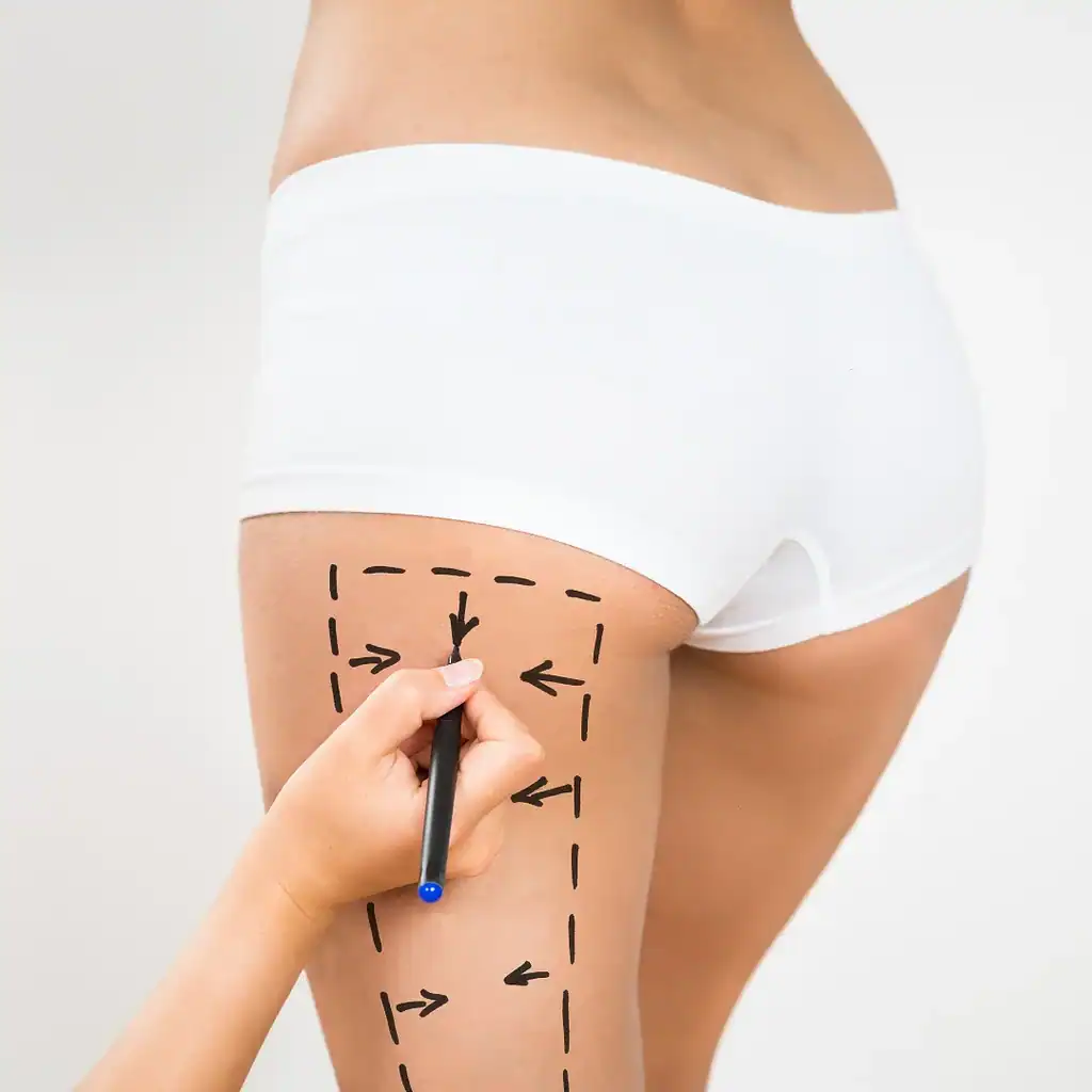 Laser Lipo Wellington FL 14 img