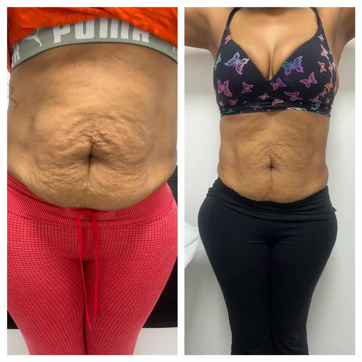 How Semaglutide works for weight loss in Lake Worth at Majestic Aesthetics